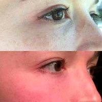 Laser Blepharoplasty Before And After (17)
