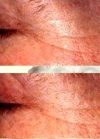 Lower Lid Blepharoplasty Wrinkles Before And After