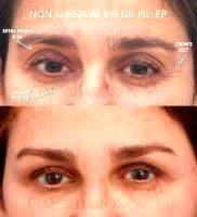 Non Surgical Eyelid Filler For Eyes Asymmetry
