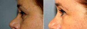 47 Yea Old Female, Upper Lid Blepharoplasty And Fat Grafting By Dr. Lucie Capek, MD, Latham Plastic Surgeon