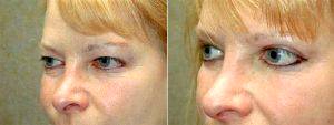 Bilateral Upper Blepharoplasty And Lower Lid Pinch Before And After By Dr James Wire, MD, Minneapolis Plastic Surgeon (2)