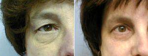Dr Amy T. Bandy, DO, FACS, Newport Beach Plastic Surgeon - Upper And Lower Eyelid Blepharoplasty