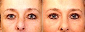 Dr Bryan Mendelson, FRACS, FACS, Melbourne Plastic Surgeon - 52 Year Old Woman, And 4 Months Following Upper Lid Blepharoplasty