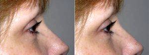 Dr Danielle DeLuca-Pytell, MD, Troy Plastic Surgeon - Upper And Lower Eyelid Lift