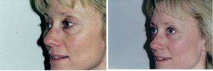 Upper And Lower Eyelid Lift By Dr Fara Movagharnia, DO, FACOS, Atlanta Plastic Surgeon