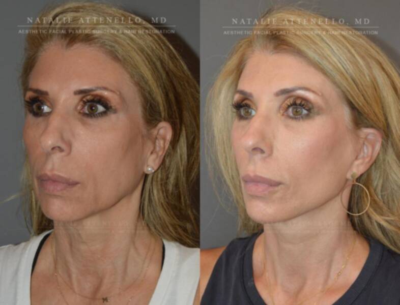 Doctor Natalie Attenello Aesthetic Facial Plastic Surgery And Hair