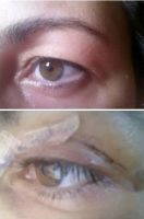 Blepharoplasty Dramatically Improves The Appearance Of Tired, Droopy Eyes