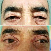 Blepharoplasty Surgery Can Be Performed On Upper Eyelids, Lower Eyelids, Or Both