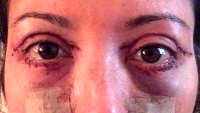 Blepharoplasty eyelid recovery timeline