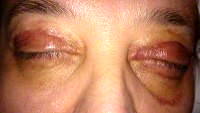 Blepharoplasty eyelid surgery recovery