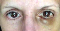 Blepharoplasty recovery blog swelling and bruising