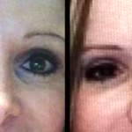 Blepharoplasty recovery pictures before and after