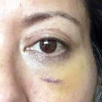 Blepharoplasty recovery pictures bruising