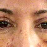 Blepharoplasty recovery pictures two weeks to minimize bruising