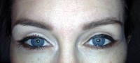 Blepharoplasty surgery and brow lift