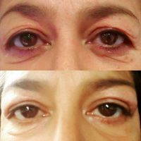 Eye Bag Removal Before And After Pic