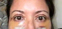 Eyelid lower surgery recovery