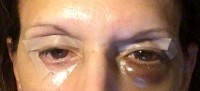 Eyelid surgery recovery pictures