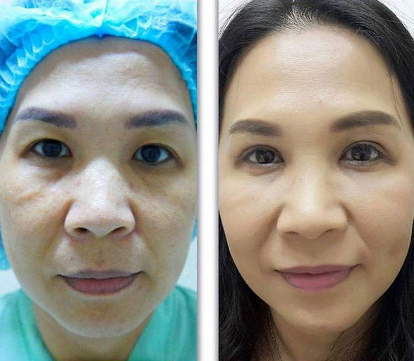 Blepharoplasty Korean Eyelid Surgery Before After Picture " Eyelid Sur...