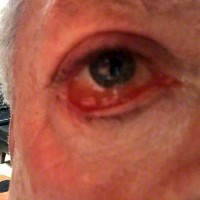 The blepharoplasty eye surgery recovery blog