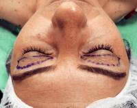 Upper Blepharoplasty Is Performed To Remove Loose Skin From The Upper Eyelid