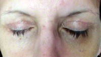 Upper eyelid blepharoplasty recovery post op