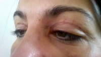 Blepharoplasty alternative treatment eyelids