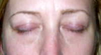 Eyelid surgery blepharoplasty dissolving stitches