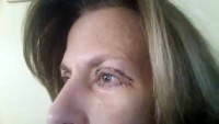 Eyes after blepharoplasty scar pictures
