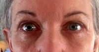 Eyes after blepharoplasty surgery photos