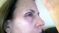 Lower eyelid surgery no anesthesia