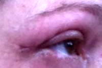 My eyes don't close after blepharoplasty eyelid surgery