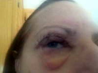 My eyes don't close after lower blepharoplasty