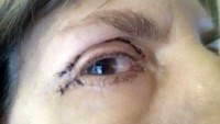 Scars after eyelid surgery pic