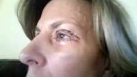The eyelid surgery no anesthesia pictures
