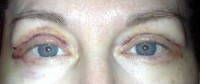 Upper blepharoplasty or brow lift photos
