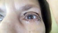 Upper eyelid surgery scars photo
