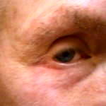 Eyelid surgery tired eyes before