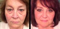 Blepharoplasty Procedure Can Refresh The Appearance Of The Face
