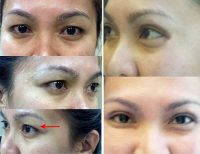 Eyelid Surgery (Blepharoplasty) Seattle & Everett - Pratt Plastic Surgery