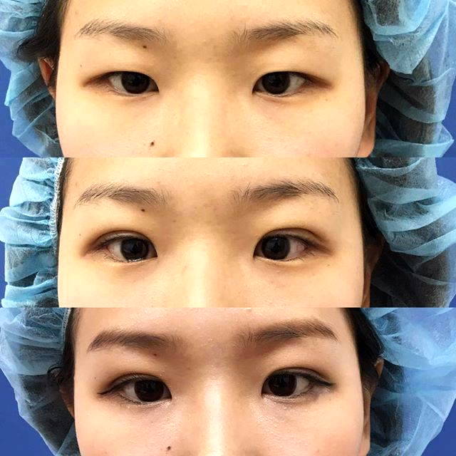 double eyelid surgery before and after