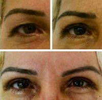 double eyelid surgery perth