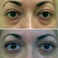 eyelid removal