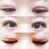 Asian Cosmetic Eye Surgery