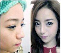 Asian Eye Lift Plastic Surgery