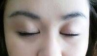 Asian Eye Lift Surgery Procedure
