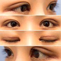 Asian Eye Surgery