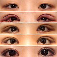Asian Eye Surgery Creates A Fold In The Upper Eyelids