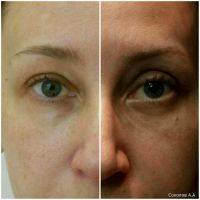 blepharoplasty eyelid surgery cost