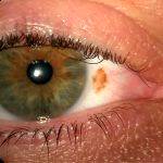 Blepharoplasty Complications Pictures (15)